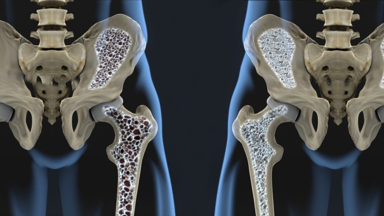 REMODELING OSSEO E&nbsp;OSTEOPOROSI