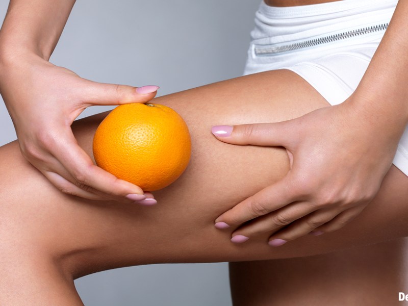 CELLULITE, RITENZIONE E …&nbsp;ALIMENTAZIONE